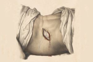 Drawing of a torso with a wound on the flank.